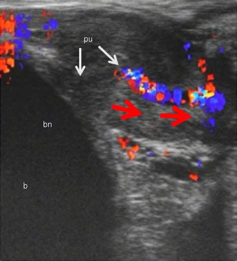 Male squirting: Analysis of one case using color Doppler ...